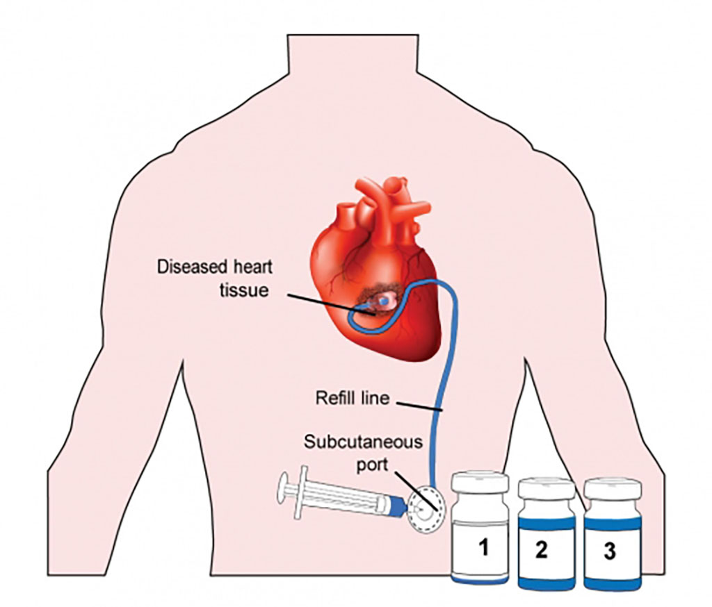 illustration of Therepi  use