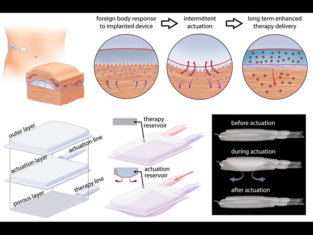 The drug-delivery system includes an actuator that repeatedly inflates and deflates the device for five minutes every 12 hours. This mechanical deflection prevents immune cells from accumulating around the device.