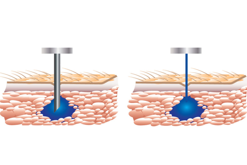 illustration of non-needle device