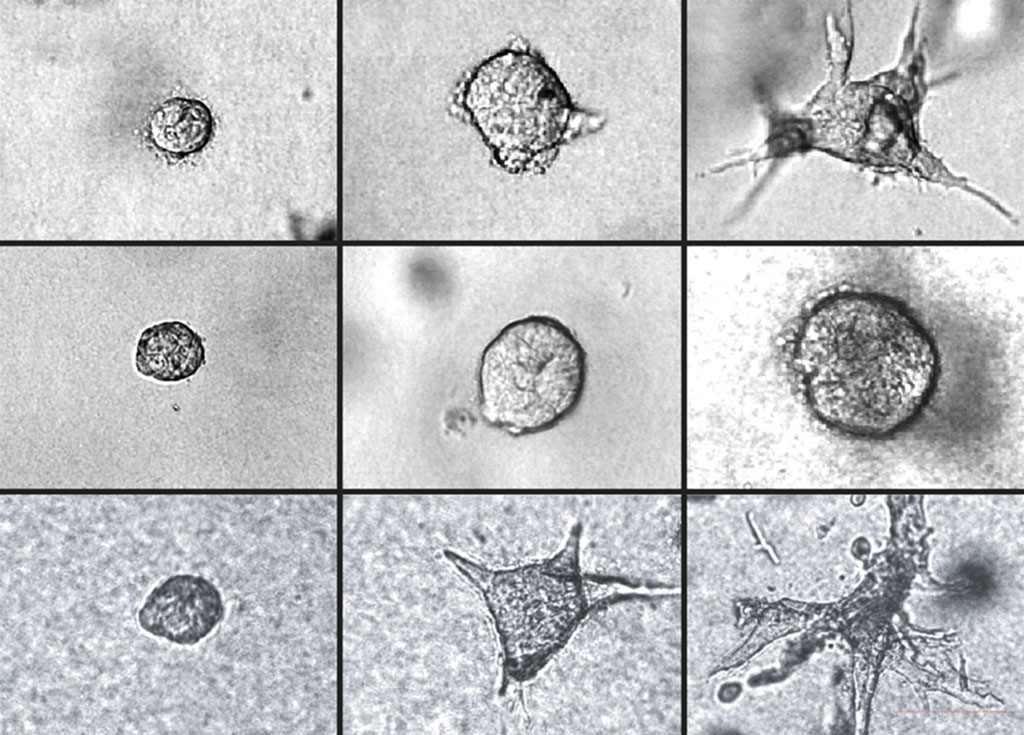 tumor cells at various progressions